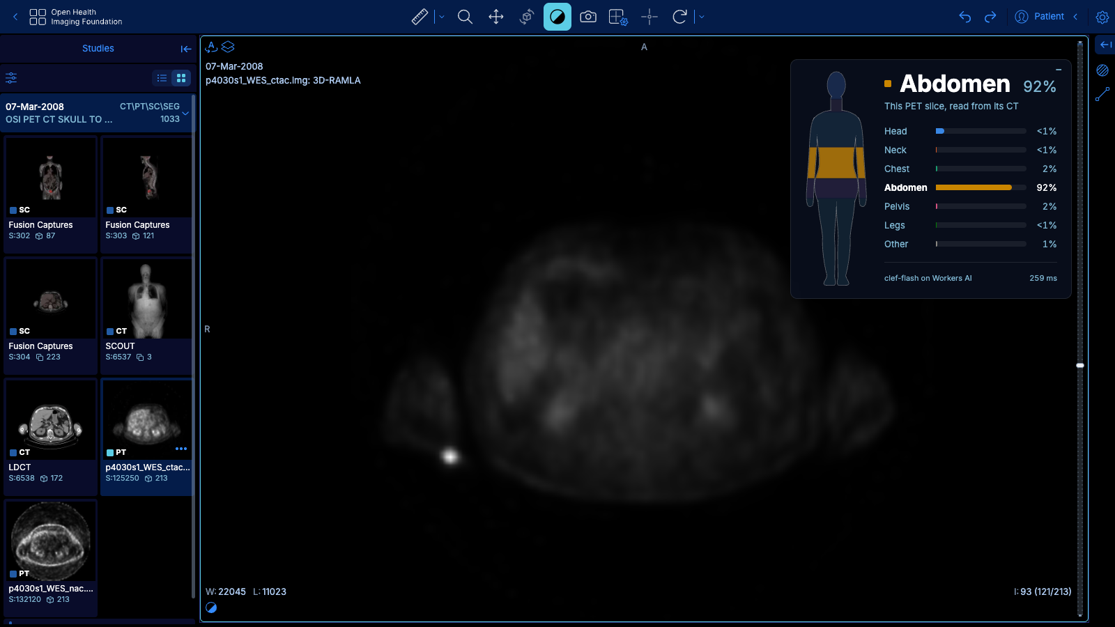 A PET slice labelled from its CT
